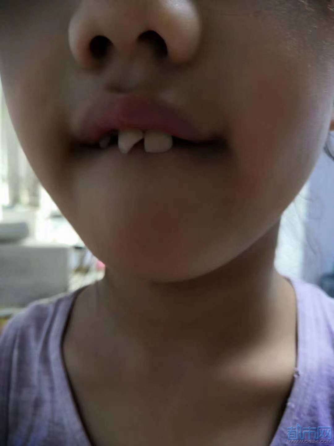 9岁门牙龅牙图片